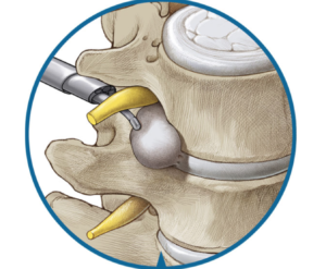 A diagram of a spine showing metal rod like medical tool being inserted in between the nerves of the vertebrae cause them to expand.
