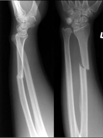 FOREARM FRACTURES - Texas Orthopedic and Spine Associates