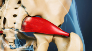 Deep Gluteal Syndrome  Orthopedics Sports Medicine