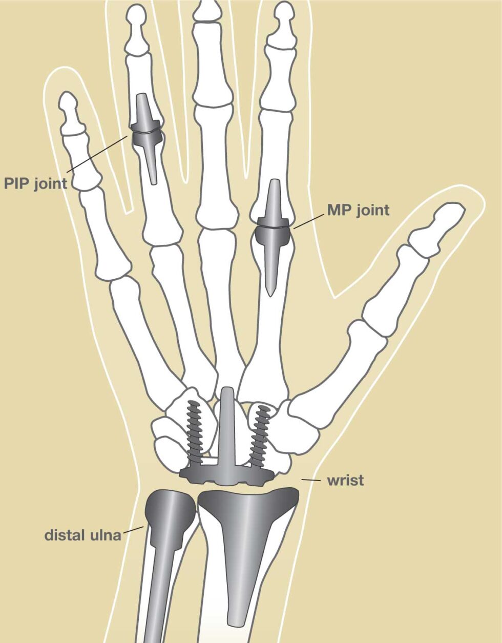 Mpcjs Hand MP joint arthroplasty - Texas Orthopedic and Spine Associates