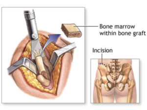 A Diagram showing bone marrow being inserted into a bone graft.