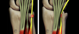 3D model of the tendon in the wrist slowly wearing down due to repetitive motions.