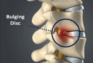 A diagram showing a spine with one of the disc developing a bulge. The area is labeled and circled as Bulging Disc. 