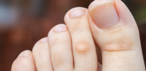 Image of someone's foot with a bump callus on top of the knuckle of their toe.