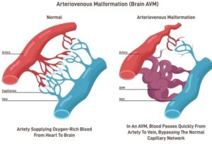 A diagram of 2 different arteries. The left diagram displays a normal artery while the right has a purple squid like sac connected the arteries. 