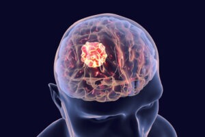 3D diagram showing a brain with a large orange and red lump in the brain.