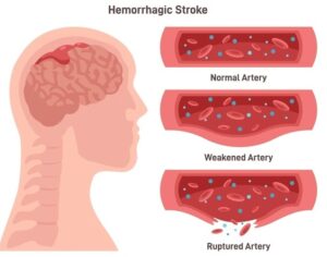 A diagram showing the difference between arteries that are normal, weakened, and ruptured causing a brain hemorrhage. 