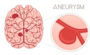 Diagram showing bulges of blood in the brain.