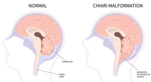 Two diagrams of a person's brain. The left diagram showing the cerebellum in a more ball shape while the the one on the right is more elongated and drags down.