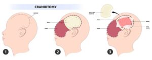 Diagram showing the process of a craniotomy where a piece of the skull is removed to gain access to the brain.