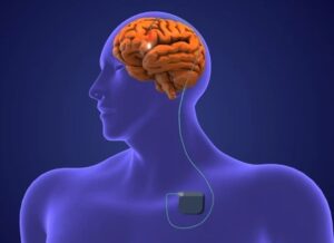3D model of a person's brain being attached to a device that emits electrodes to part of the brain.
