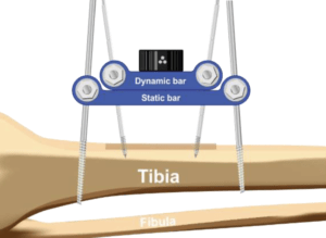 Medical illustration of lower leg circulation and tibial transport procedure for non-healing foot wounds.