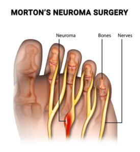 diagram of the foot and morton's neuroma surgery